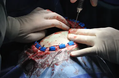 PATIENT SPECIFIC IMPLANT TECHNOLOGY