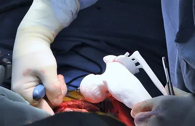 BONE TUMOR RESECTION