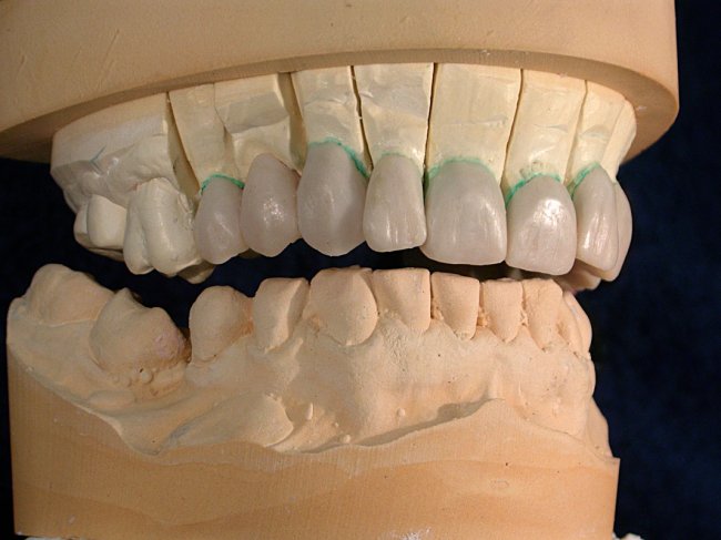 dentes protésicos
